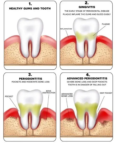 Periodontal Treatment