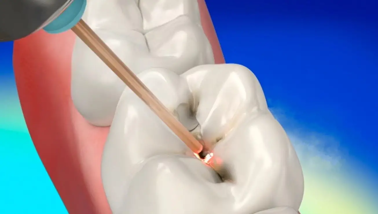 Laser Dentistry Image